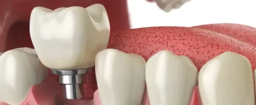 Cosmetic Dental Implant