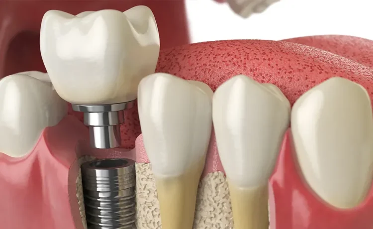 Cosmetic Dental Implant