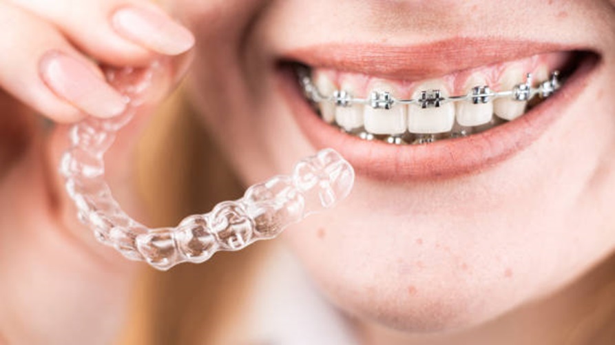 Traditional Braces