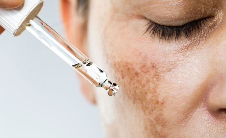 Hyperpigmentation Treatment