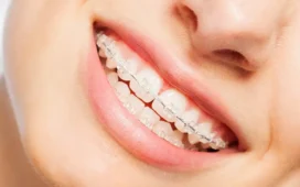 Traditional Braces