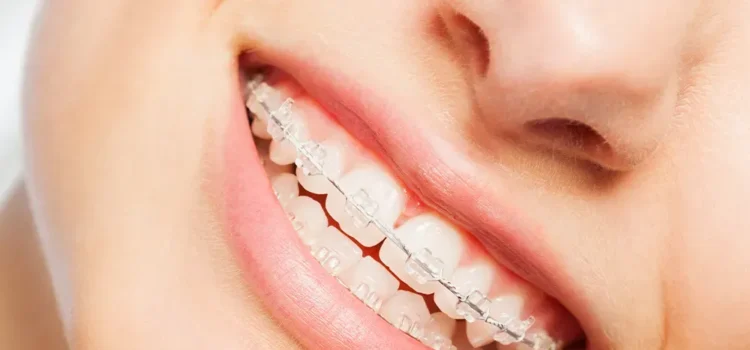 Traditional Braces