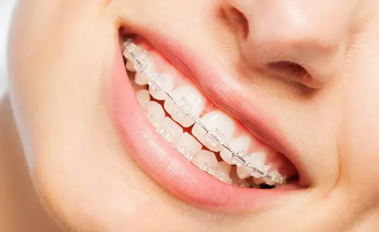 Traditional Braces