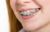 Traditional Braces