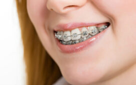 Traditional Braces