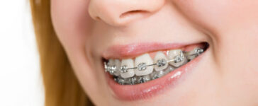 Traditional Braces