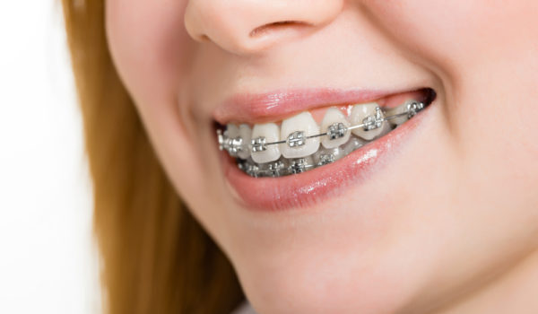 Traditional Braces