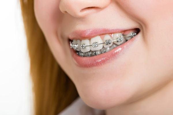 Traditional Braces